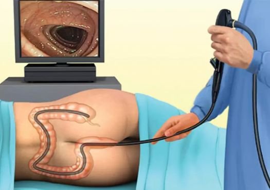 Sigmoidoscopy
