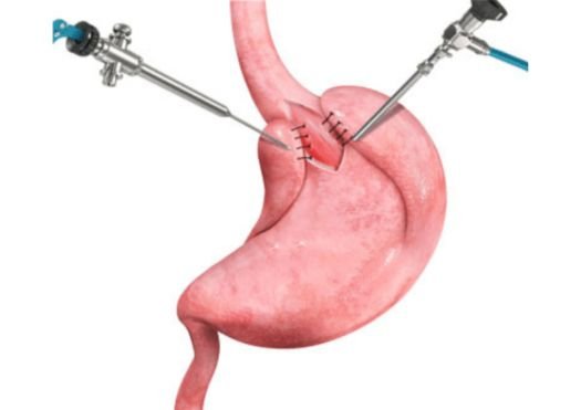 Anti-Reflux Procedures