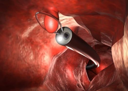 EMR (Endoscopic Mucosal Resection)