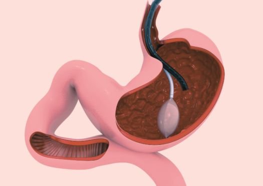 Endobariatrics (Gastric Balloon)