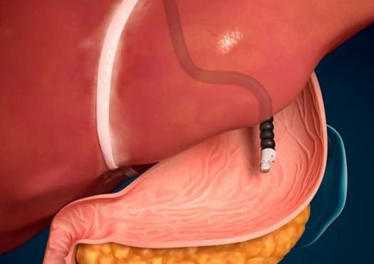 EUS (Diagnostic & Therapeutic)