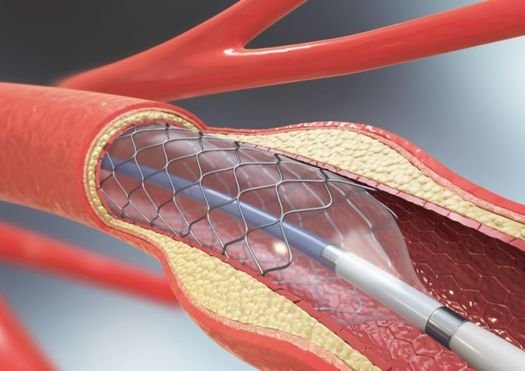 Metal Stent Placement