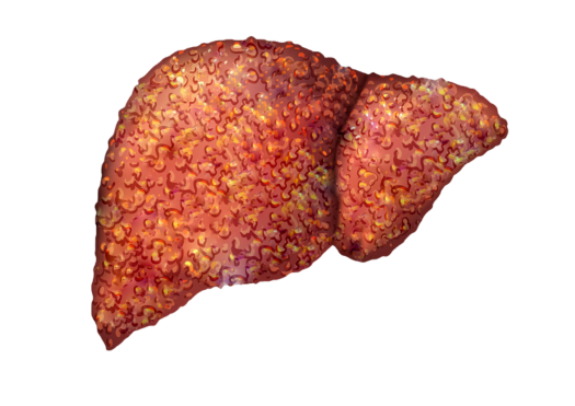 Cirrhosis